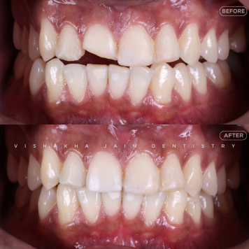 Restore Damaged Teeth with Bonding, Veneers & Crowns