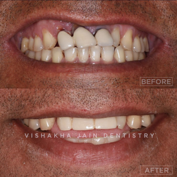 Cosmetic Solutions for Chipped Teeth at Seraphic Dental