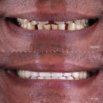 Get Quick & Affordable Chipped Tooth Repair Today