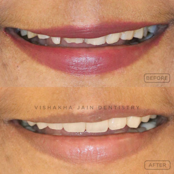Fix Chipped or Broken Teeth with Painless Dental Care