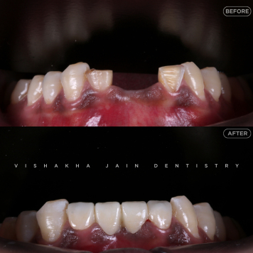 Broken or Chipped Tooth? Visit Indore’s Trusted Dental Experts