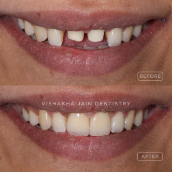 Chipped Teeth Treatment in Indore – Restore Your Smile