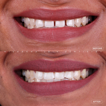 Best Teeth Gap Correction in Indore – Affordable & Effective