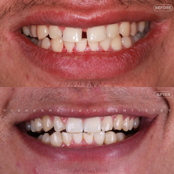 Fix Your Teeth Gaps with Braces or Veneers
