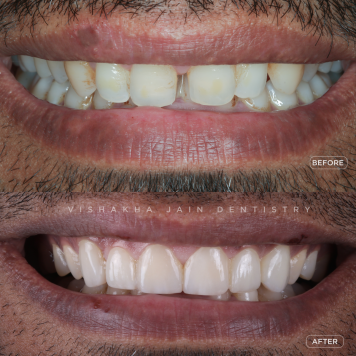 Permanent Solution for Teeth Gaps – Book Your Consultation Today