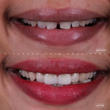 Say Goodbye to Gapped Teeth – Smile with Confidence