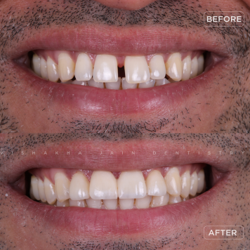 No More Gaps! Invisible Aligners for Teeth Gap Closure