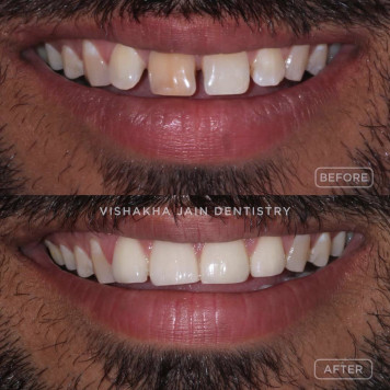 Close Teeth Gaps with Advanced Dental Treatments