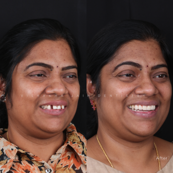 Best Dental Implant Clinic in Indore – Seraphic Dental