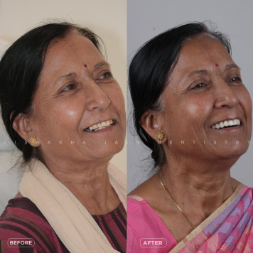Get Full Mouth Fixed Teeth in Just 1 Day at Seraphic Dental