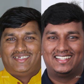 Dental Implants in Indore | Full Mouth Fix Teeth in 1 Day – Seraphic Dental