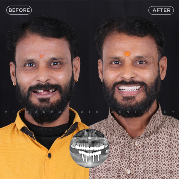 Affordable & Permanent Dental Implants in Indore