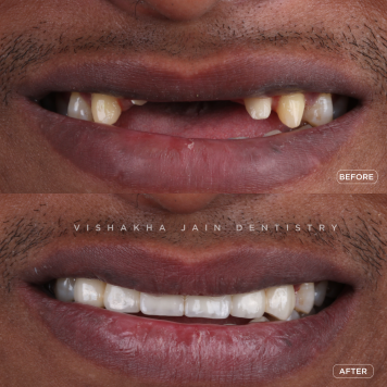 Missing Teeth? Discover Advanced Tooth Replacement Solutions Today