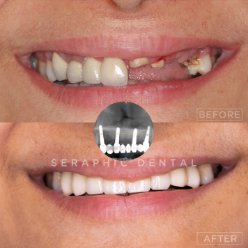 Affordable Dental Implants – Permanent Tooth Replacement