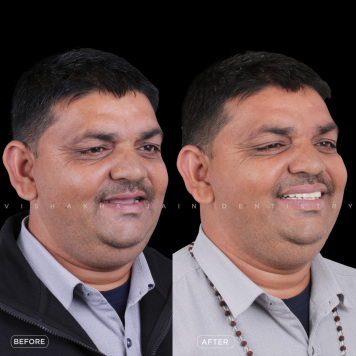 Advanced Dental Implant Procedures for a Confident Smile