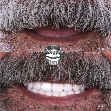 Missing Teeth? Get Natural-Looking Dental Implants Today
