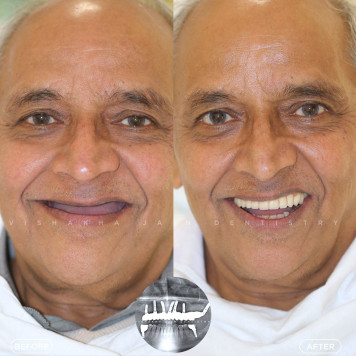 Best Dental Implant Clinic in Indore – Seraphic Dental