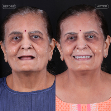 Same-Day Full Mouth Dental Implants at Seraphic Dental