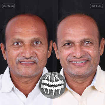 Full Mouth Implant Solution in 1 Day – Fast, Painless & Permanent