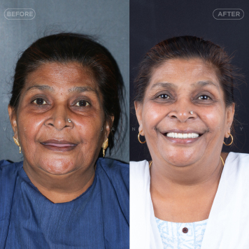 Fix Missing Teeth in Just 1 Day – Book Your Smile Makeover Now