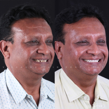 Get a Perfect Smile with Digital Smile Designing