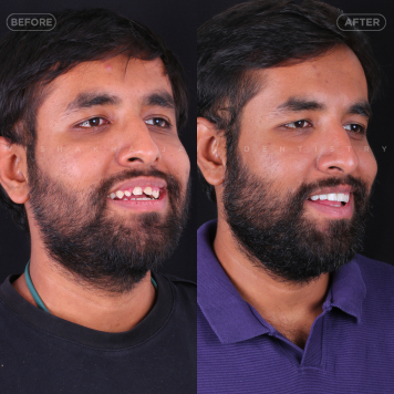Personalized Smile Design for Natural, Lasting Results