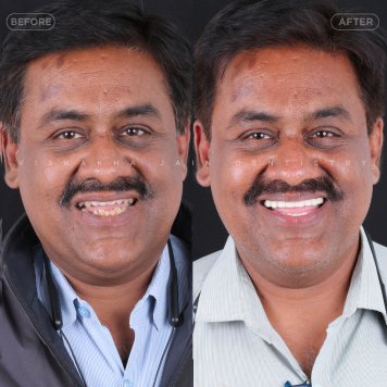 Seraphic Dental – Best Clinic for Smile Design in Indore