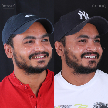 Enhance Your Confidence with Cosmetic Smile Design