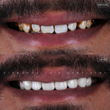 Safe & Effective Teeth Whitening Services in Indore