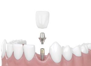 Read more about the article Are Dentures or Dental Implants Better?