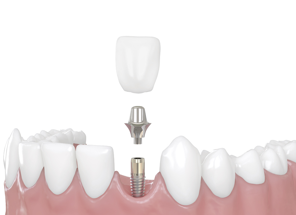 You are currently viewing Are Dentures or Dental Implants Better?
