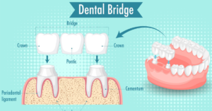 Dental bridges in Indore