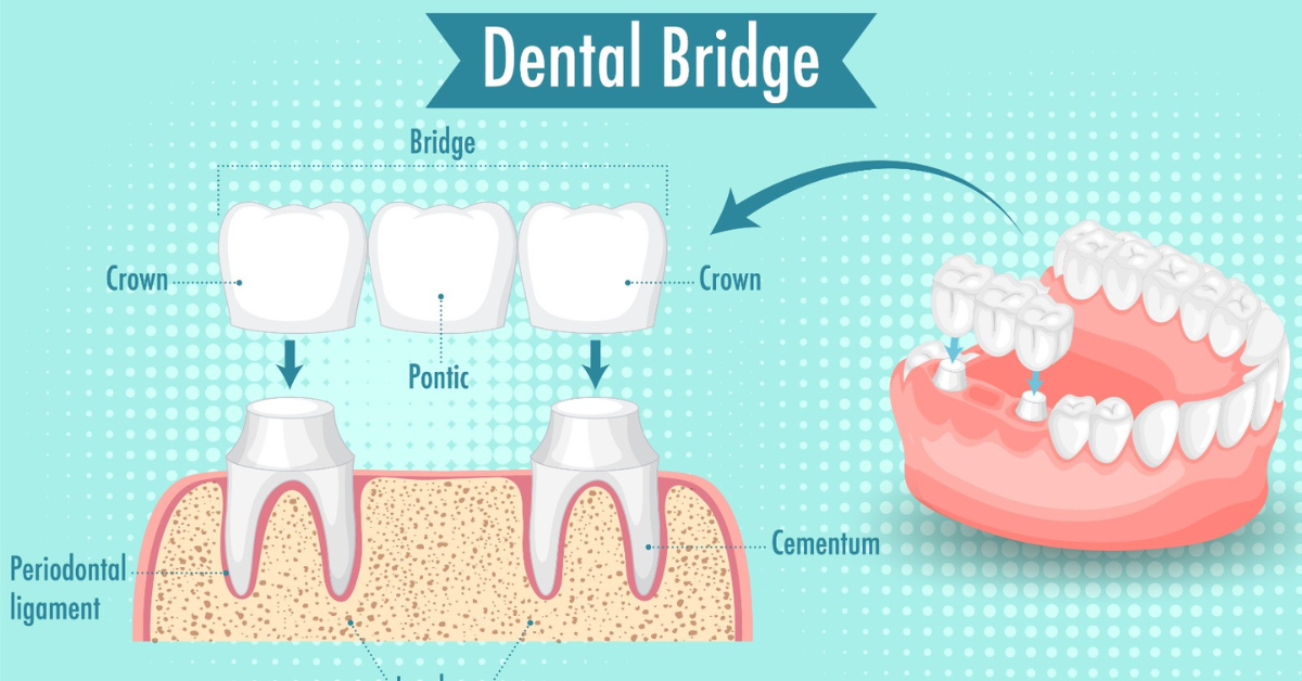 You are currently viewing Different Types of Dental Bridges