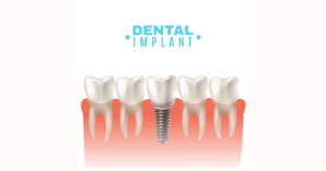 Read more about the article Debunking Common Myths About Dental Implants
