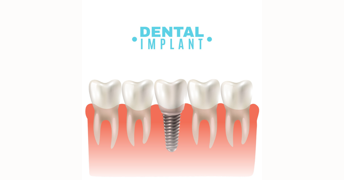 You are currently viewing Debunking Common Myths About Dental Implants