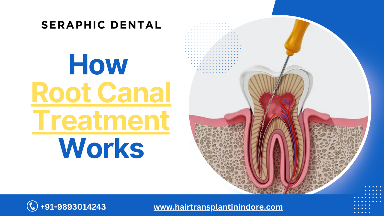 You are currently viewing How Root Canal Treatment Works: A Detailed Look at the Steps Involved