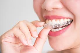 Clear Aligner Braces