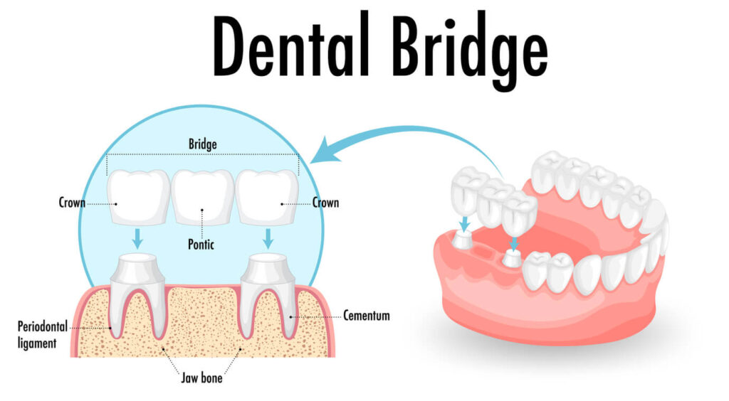 Dental bridges