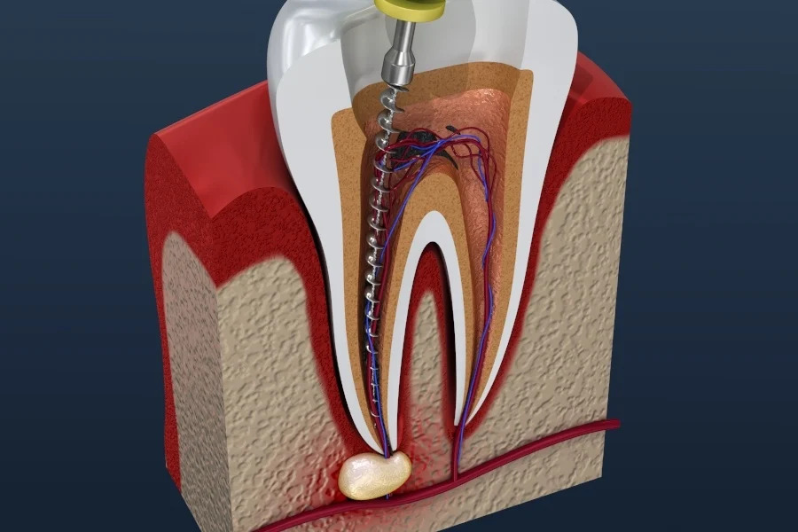 root canal treatment