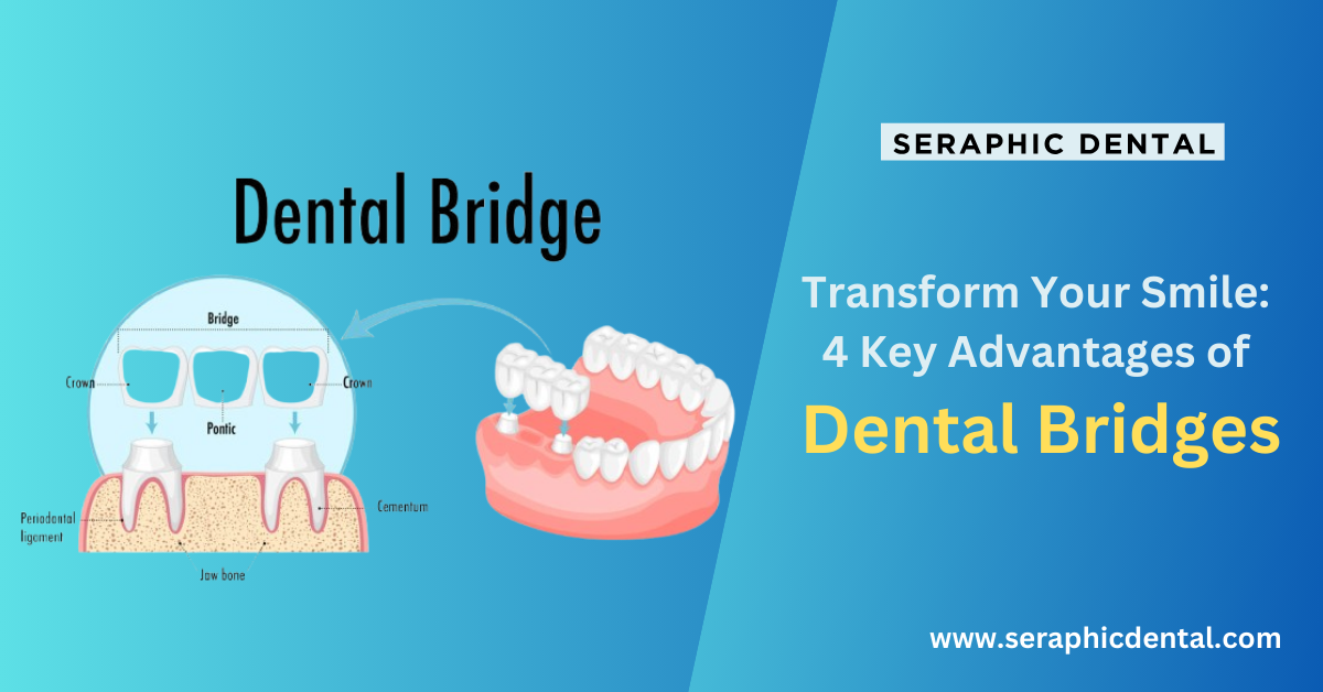 You are currently viewing Transform Your Smile: 4 Key Advantages of Dental Bridges