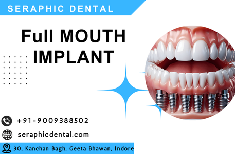 You are currently viewing Full Mouth Implants in Indore: The Path to a Perfect Smile with Seraphic Dental Implants