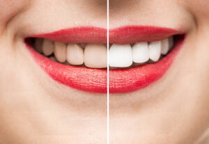 Read more about the article Smile Makeover in Indore | Transform Your Smile at Seraphic Dental