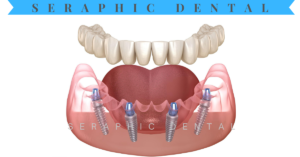 Read more about the article Step-by-Step Dental Implant Procedure