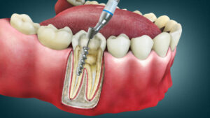 Read more about the article Root Canal Treatment in Indore | Pain-Free Care at Seraphic Dental