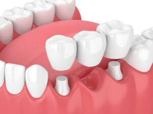 Read more about the article Best Dental Caps in Indore