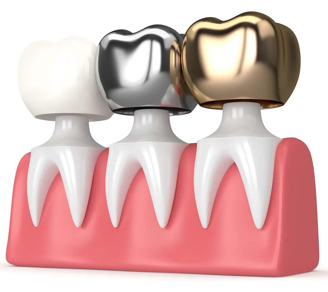 Zirconia Dental Caps in Indore | Seraphic Dental Clinic