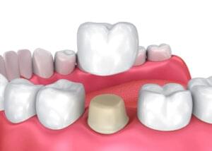 Dental-Crown