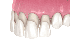 Dental-Veneers