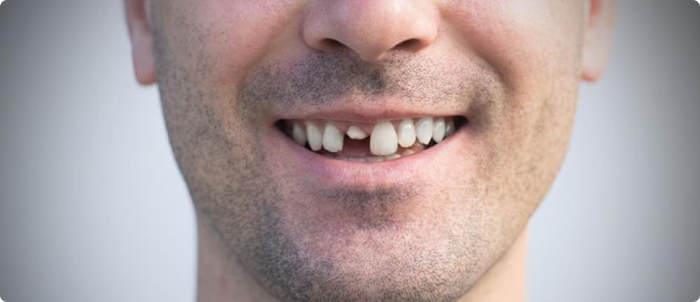 Chipped and Broken Teeth